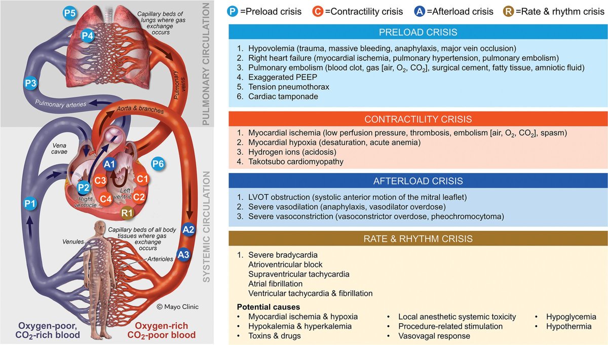 Check out the review article: Causes of Perioperative Cardiac Arrest: Mnemonic, Classification, Monitoring, and Actions 

buff.ly/3XoQ9In 

🚫 Cardiac arrest can result from preload, contractility, afterload, or rate/rhythm crises.