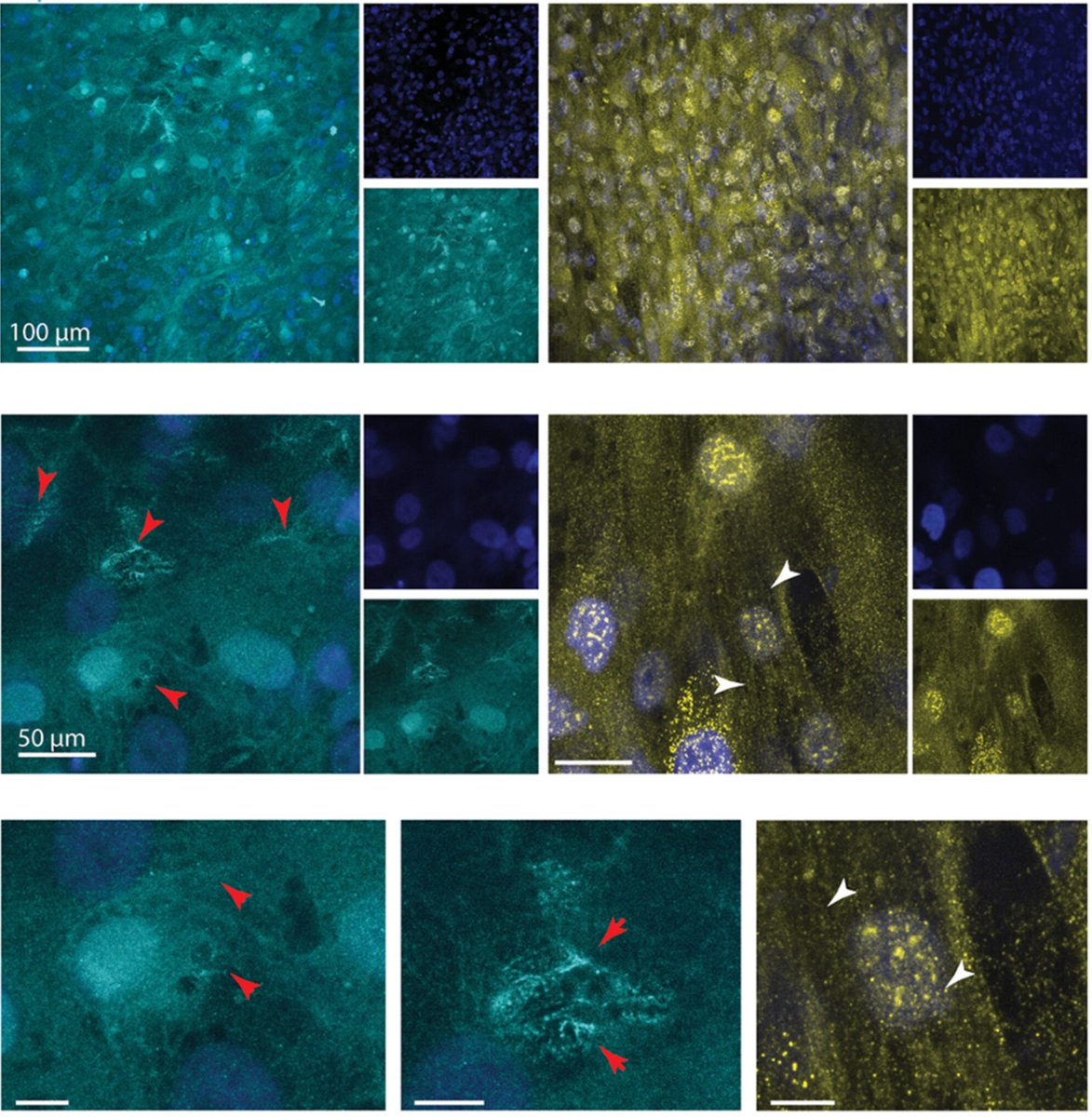organoidscience's tweet image. Investigators 🛠️ engineered a kidney glomerulus-on-a-chip that recapitulated glomerular #morphogenesis and 🚧 barrier function using a biomimetic ultrathin membrane and #hiPSCs.

@ScienceAdvances | bit.ly/3RmkT8X