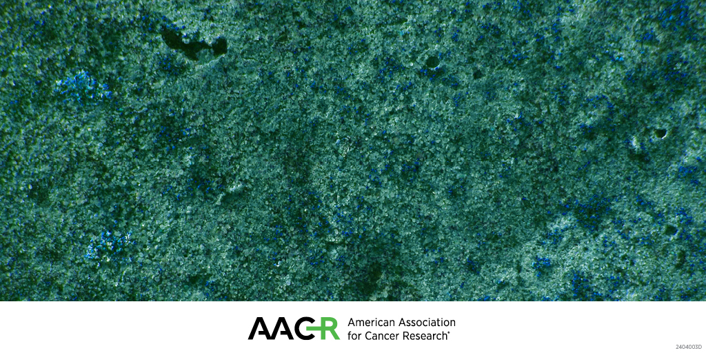 AACR (@aacr) on Twitter photo Metabolism and Pancreatic Cancer:
Alec C. Kimmelman, Nada Kaalany, Costas A. Lyssiotis, and Kamiya Mehla will address this topic in a plenary session at the AACR Conference on Pancreatic Cancer (Sept 15-18, Boston).
bit.ly/4ctphLK
#AACRpan24 <a href="/nada_kalaany/">Nada Kalaany</a> <a href="/LyssiotisLab/">Lyssiotis Lab</a> Metabolism and Pancreatic Cancer:
Alec C. Kimmelman, Nada Kaalany, Costas A. Lyssiotis, and Kamiya Mehla will address this topic in a plenary session at the AACR Conference on Pancreatic Cancer (Sept 15-18, Boston).
bit.ly/4ctphLK
#AACRpan24 <a href="/nada_kalaany/">Nada Kalaany</a> <a href="/LyssiotisLab/">Lyssiotis Lab</a>