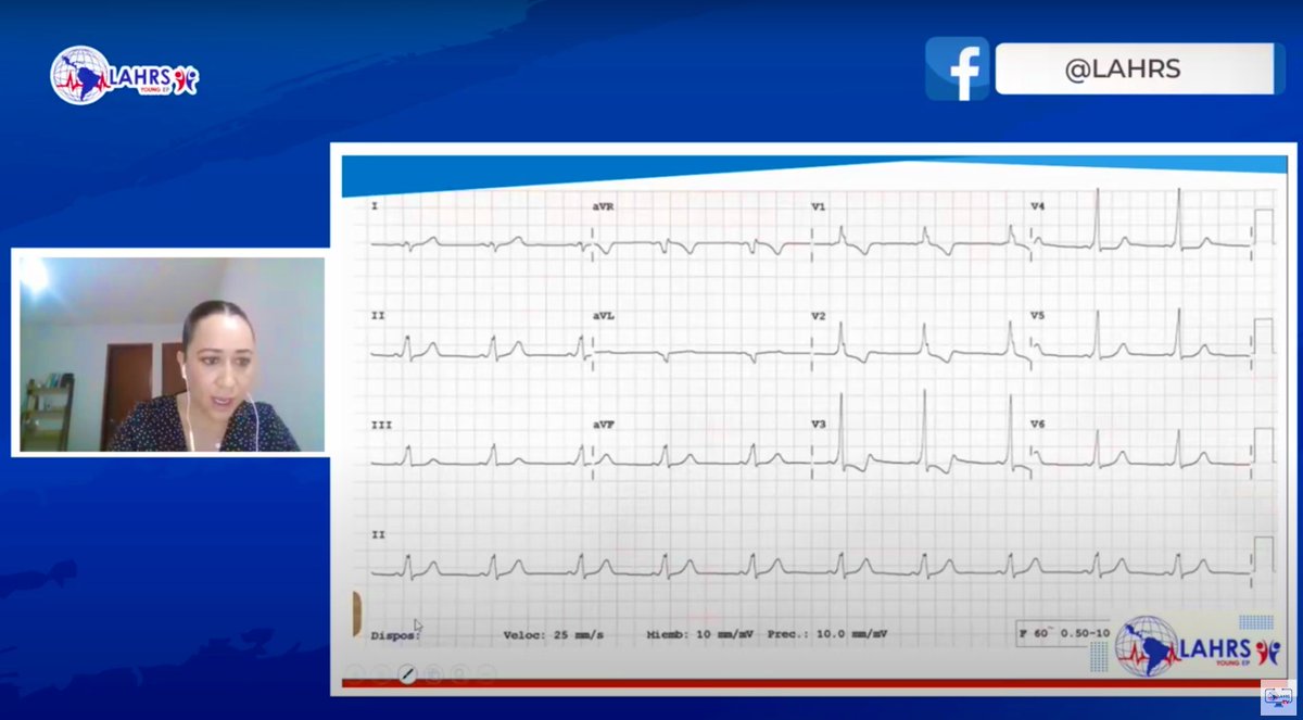 Reviva el #webinarLAHRS 
La Dra. Diana Ruiz 🇲🇽 nos guía en la exploración de 2 casos clínicos desde el análisis de los ECG

Qué ve el electrofisiologo en el análisis de los electrocardiogramas?

#LAHRSTV 
youtu.be/Bgi2KosYGdM?si…
