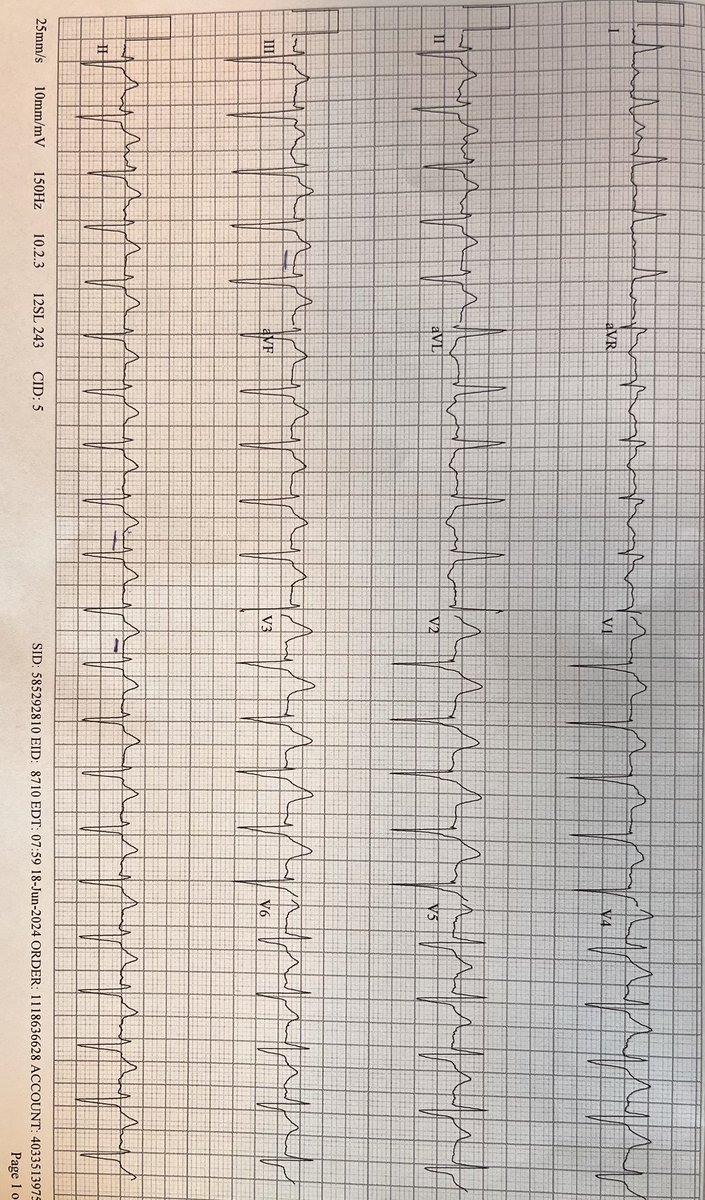 Less_is_More_MD's tweet image. What is happening here? Aflutter - too slow? 
AT 2:1? Rather normal Echo