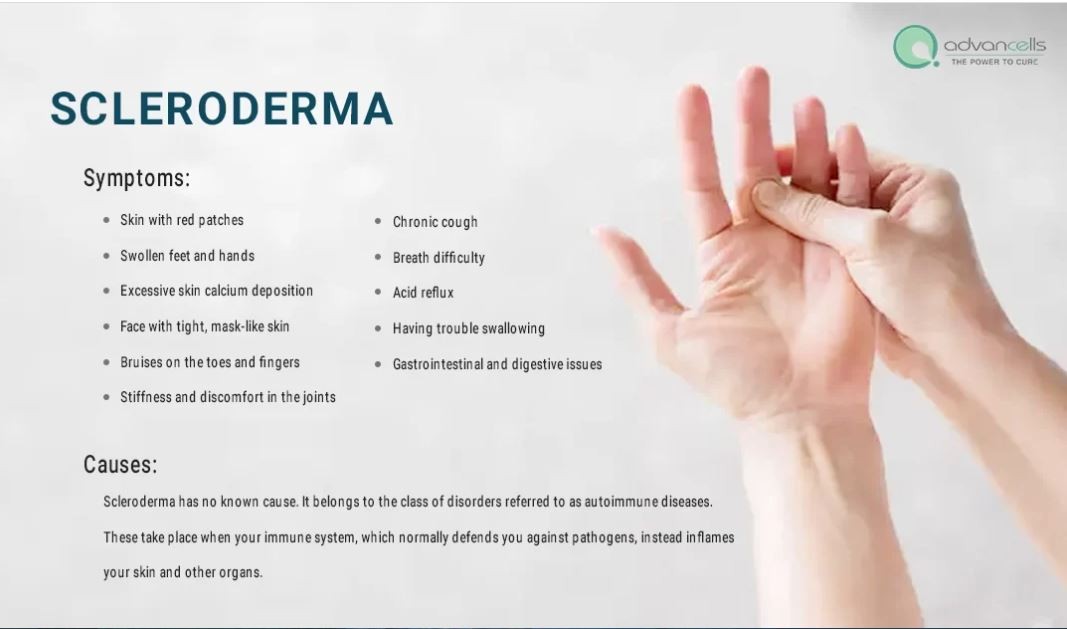 CHCSga's tweet image. Did you know that there is no known cause of Scleroderma? Scleroderma takes place when your immune system inflames your skin and other organs. Check out the symptoms of Scleroderma in this picture below! #georgiapca #SclerodermaAwarenessMonth