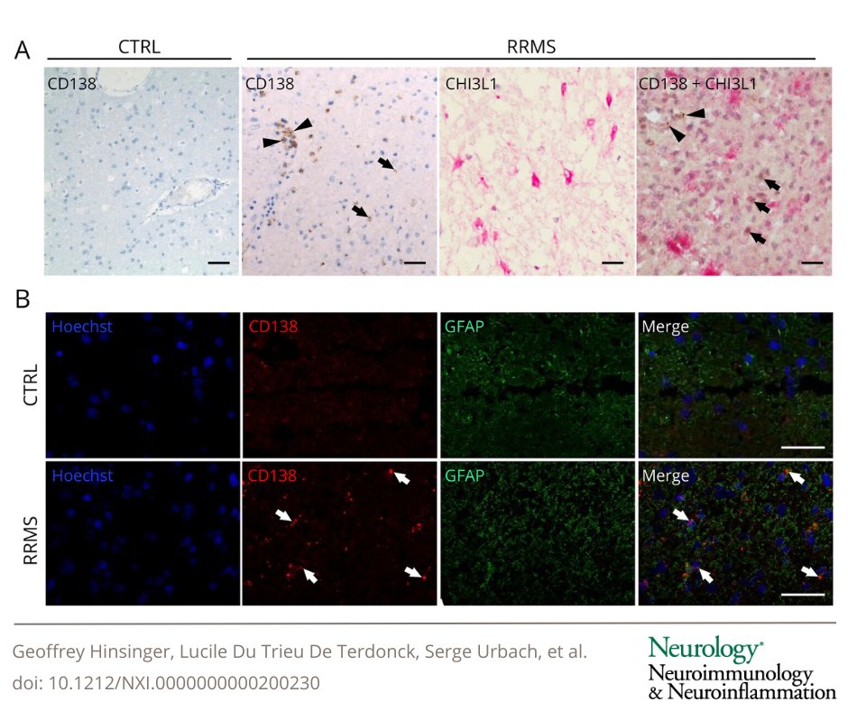 Study findings identify CD138 as a specific CSF biomarker for multiple sclerosis: bit.ly/3Vu8zVM

#NeuroTwitter #MS