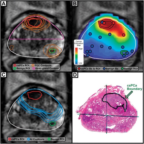 Applied Radiation Oncology (@applied_radonc) on Twitter photo Study Reports Unfold AI Helps Physicians Identify Extent of Prostate Cancer With 84% Accuracy
Learn more ➡️ bit.ly/3RAa43z
<a href="/AvendaHealth/">Avenda Health</a> <a href="/JUrology/">Journal of Urology</a>
#RadNews #Radiology #Imaging #AI #ProstateCancer Study Reports Unfold AI Helps Physicians Identify Extent of Prostate Cancer With 84% Accuracy
Learn more ➡️ bit.ly/3RAa43z
<a href="/AvendaHealth/">Avenda Health</a> <a href="/JUrology/">Journal of Urology</a>
#RadNews #Radiology #Imaging #AI #ProstateCancer