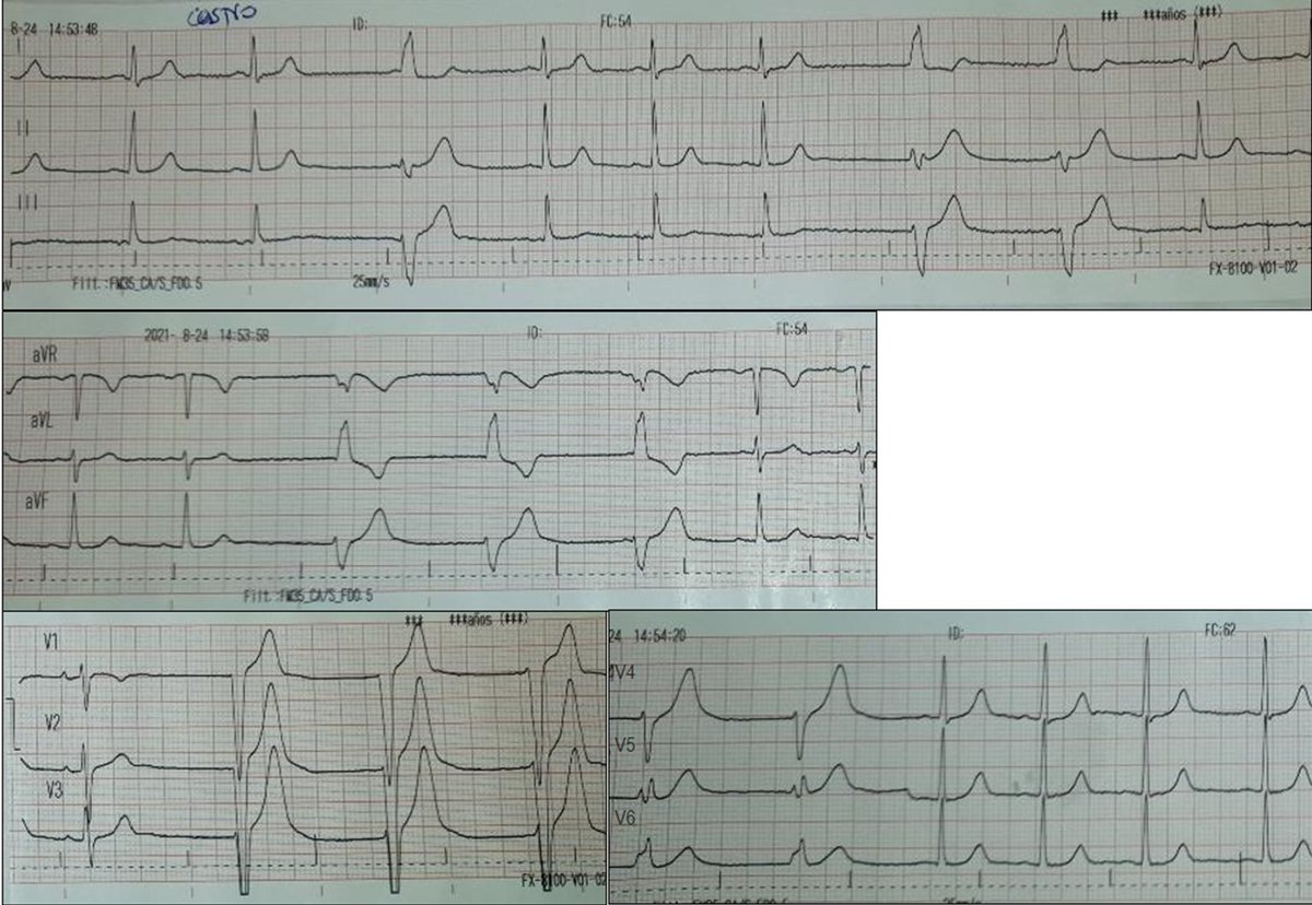 Doc_AleCuesta's tweet photo. Masculino, 18 años, deportista, asintomático, sin antecedentes.
ECG en valoración predeportiva. ¿Siga siga o párese??

Male, 18 years old, athlete, asymptomatic, no history. ECG in pre-sport evaluation. Keep going or stop? https://t.co/r29OpymxN0