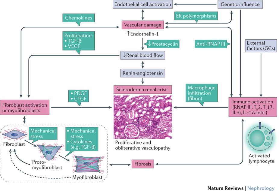 Mark_Heslin's tweet photo. Scleroderma renal crisis 

Endothelial injury ➡️ ⬇️🫘 blood flow ➡️ ⬆️renin ➡️ HTN + AKI

Risks
⭐️Diffuse skin involvement
⭐️Steroids
⭐️RNA-Pol III+ (60%)
⭐️Recent dx (<5 yrs)

Clinical
⭐️Abrupt HTN (10% normal BP)
⭐️AKI: minimal proteinuria/RBCs
⭐️MAHA (50%)

Tx: ACEi, avoid BBs https://t.co/BVPjJipl2C