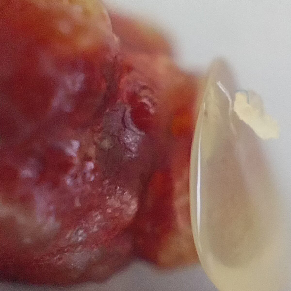 DrCesarMayorga's tweet photo. Another little monster removed from a ureter. Previous ureteral bypass got kinked and we decided to fix the catheter and removed the stone causing the primary problem. I wonder what is the mineral composition of the two structures united into one stone. #nefrovetcolombia https://t.co/nNsoJemMEQ