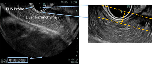 GIE (@gie_journal) on Twitter photo In Articles in Press: “EUS-guided liver palpation as a screening tool for advanced fibrosis and cirrhosis in patients with suspected metabolic dysfunction–associated steatotic liver disease: a pilot study" by Thomas J. Wang et al. giejournal.org/article/S0016-…
<a href="/ThomasWangMD/">Thomas Wang</a> <a href="/Jarshah4/">Raj Shah</a> In Articles in Press: “EUS-guided liver palpation as a screening tool for advanced fibrosis and cirrhosis in patients with suspected metabolic dysfunction–associated steatotic liver disease: a pilot study" by Thomas J. Wang et al. giejournal.org/article/S0016-…
<a href="/ThomasWangMD/">Thomas Wang</a> <a href="/Jarshah4/">Raj Shah</a>