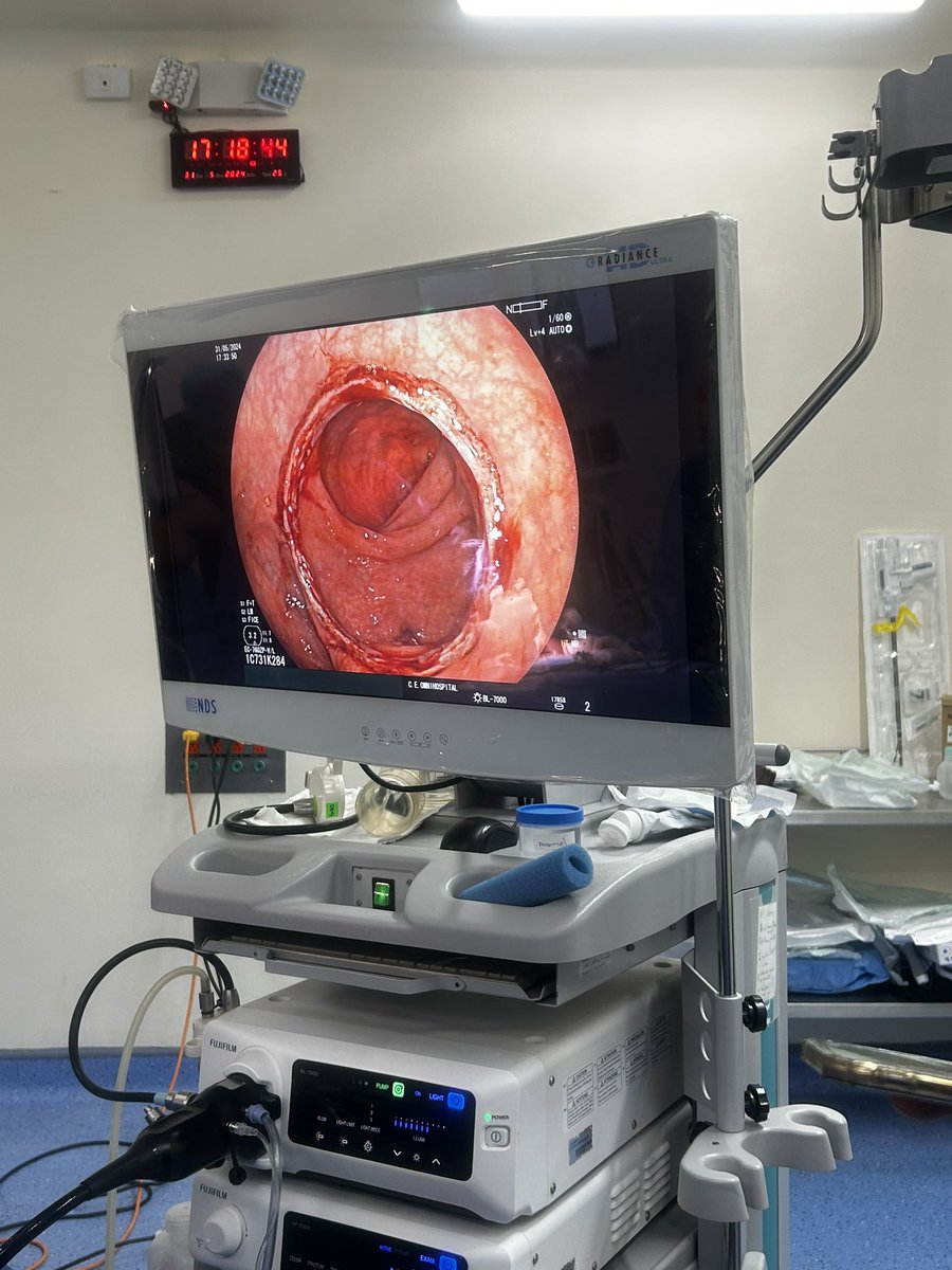 La colonoscopia intraoperatoria es una herramienta y parte de la seguridad durante una cirugía colorectal <a href="/coloproctoaec/">Coloproctología-AEC</a> <a href="/aecirujanos/">aecirujanos</a> <a href="/OMNIHospital/">Omni Hospital</a>