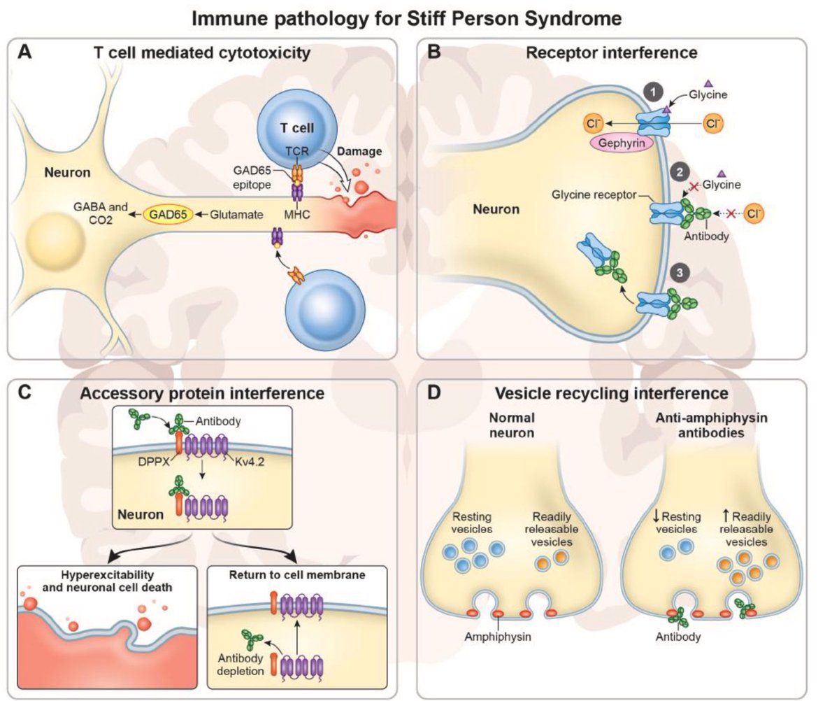Journal of Neuroimmunology (JNI) (@jni_journal) on Twitter photo Check out 👉 the latest review about Stiff person syndrome Spectrum disorders (SPSD), prognostic markers, diagnostic criteria and phenotype. <a href="/TorryJohnson/">Torry Johnson</a> & <a href="/ScottNewsome/">Scott"PuckFlicker"NewsoXe</a> Check out 👉 the latest review about Stiff person syndrome Spectrum disorders (SPSD), prognostic markers, diagnostic criteria and phenotype. <a href="/TorryJohnson/">Torry Johnson</a> & <a href="/ScottNewsome/">Scott"PuckFlicker"NewsoXe</a>