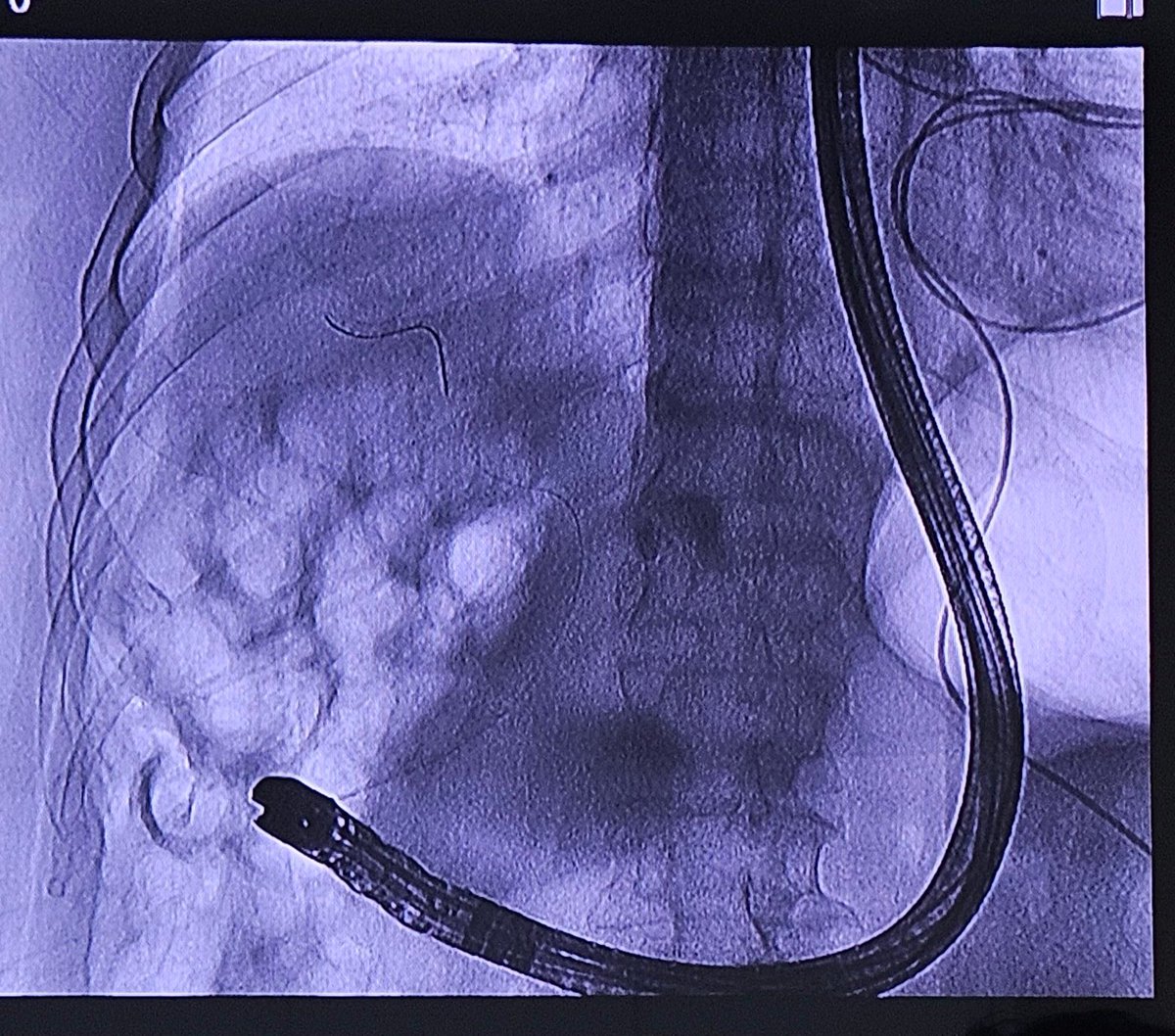 fvazquez8's tweet photo. What's wrong with this ERCP? https://t.co/yo4Xr7XDBj