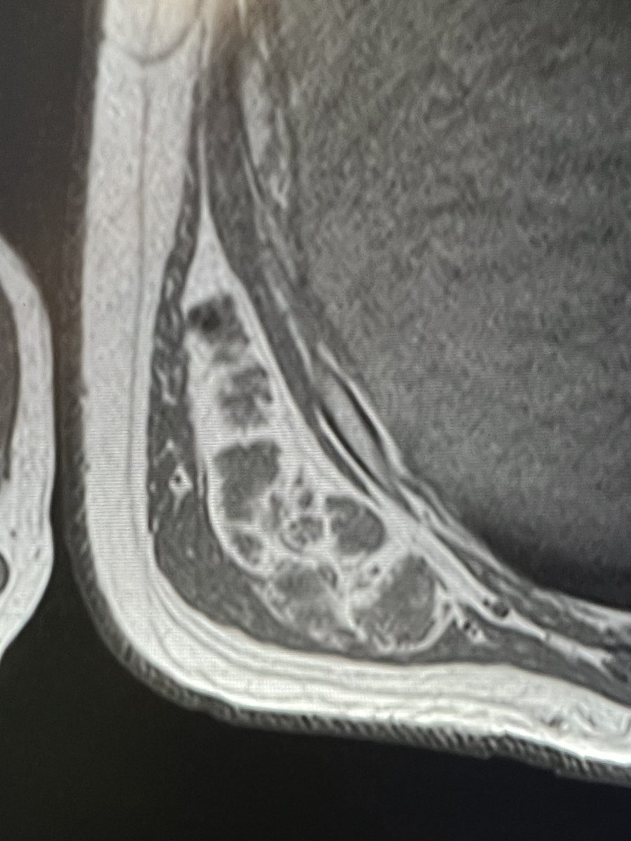 mskteachingroom's tweet photo. T1 and STIR sequences Right posterior lateral chest wall 

What is it ? 

#radres https://t.co/N0QOokwTTS