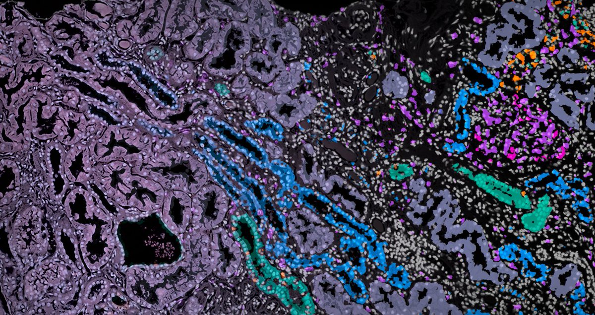 Oxford Mathematics (@oxunimaths) on Twitter photo When a team at <a href="/NDMOxford/">Nuffield Department of Medicine</a> wanted to know more about cells they were studying as part of research in to kidney disease, they found perfect partners in <a href="/OxUniMaths/">Oxford Mathematics</a> & <a href="/mpicbg/">MPI-CBG Dresden</a>.
Read about <a href="/BetterKidneys/">Katherine Bull</a> <a href="/haharrington/">Heather Harrington</a> <a href="/kfbenjamin/">Katherine Benjamin</a> & colleagues' collaboration:
maths.ox.ac.uk/node/68470 When a team at <a href="/NDMOxford/">Nuffield Department of Medicine</a> wanted to know more about cells they were studying as part of research in to kidney disease, they found perfect partners in <a href="/OxUniMaths/">Oxford Mathematics</a> & <a href="/mpicbg/">MPI-CBG Dresden</a>.
Read about <a href="/BetterKidneys/">Katherine Bull</a> <a href="/haharrington/">Heather Harrington</a> <a href="/kfbenjamin/">Katherine Benjamin</a> & colleagues' collaboration:
maths.ox.ac.uk/node/68470