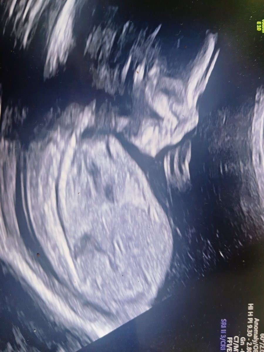 millagan23's tweet image. New #Fella on the way. 
I'm gonna be a grandad very soon. 🫶