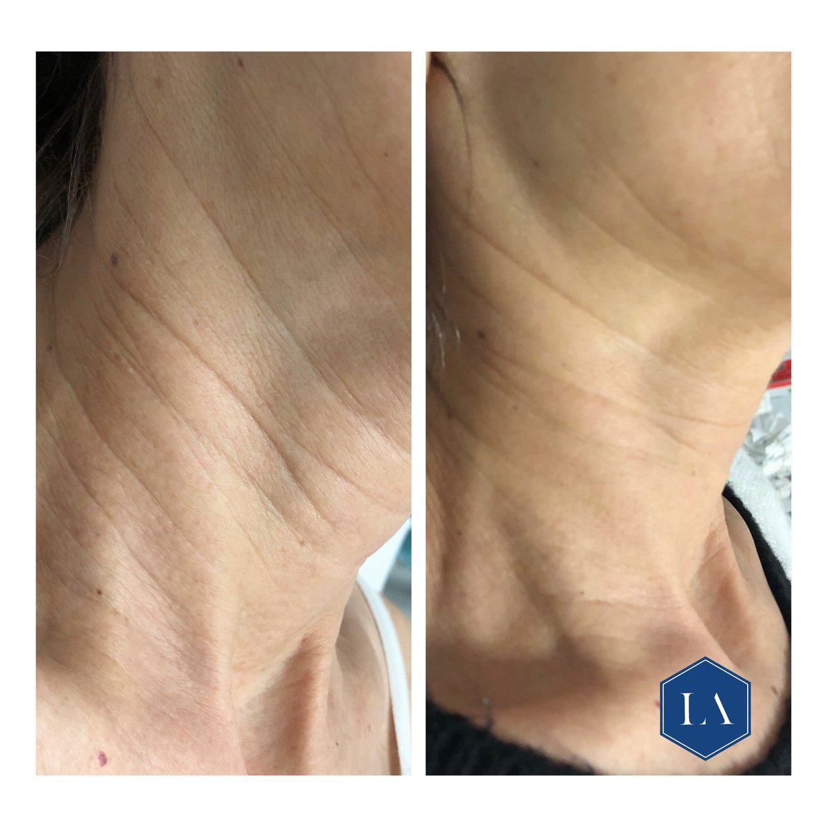 LuxtonAesthetic's tweet image. 4 Weeks Post 1ml Volite to the Neck Area ✨Volite creates a beautiful glow to the skin, lightening deeper lines and providing a fresher appearance. For optimal results, we recommend 2 treatments, 4 weeks apart.

#Volite #SkinGlow #FresherSkin #ReducingLines #NeckTreatment