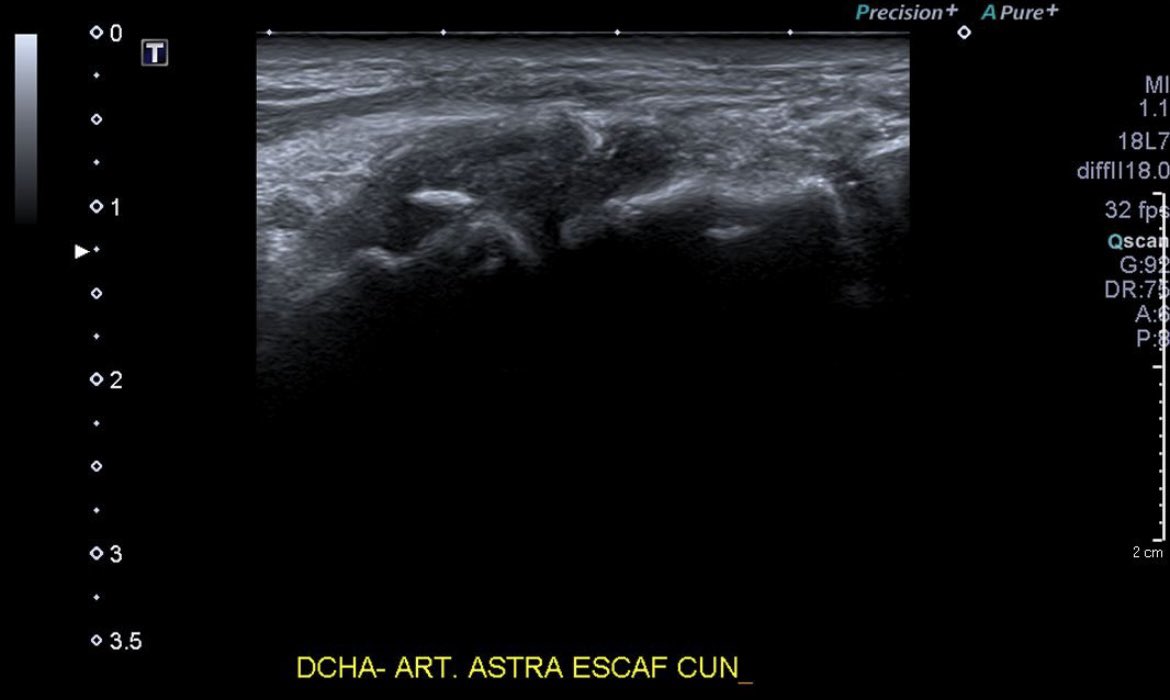 JM_Zulueta_O's tweet photo. Recent ankle sprain, pain in the dorsal region of the midfoot. Classic sign on X-ray (interpreted as normal in the ER), complementary ultrasound for persistent pain. Diagnosis? https://t.co/4znrzyJbHE