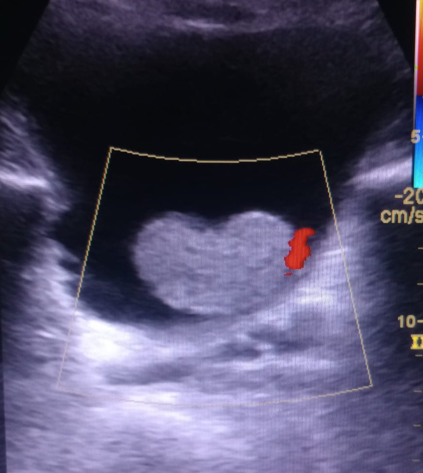 So we meet again !!!! 😏
#charmingprostate
<a href="/endouroacademy/">Endourology Academy</a> <a href="/Miguel_pitufo/">J.Miguel Suarez</a> <a href="/TFL_URO_APIS/">APIS KidneyStone Institute, TFL EndoUrology Center</a> <a href="/niteshkuro/">Nitesh Kumar</a> <a href="/Mariana38298231/">Mariana Dominguez</a> <a href="/CsarLevJM1/">César Leví JM</a>