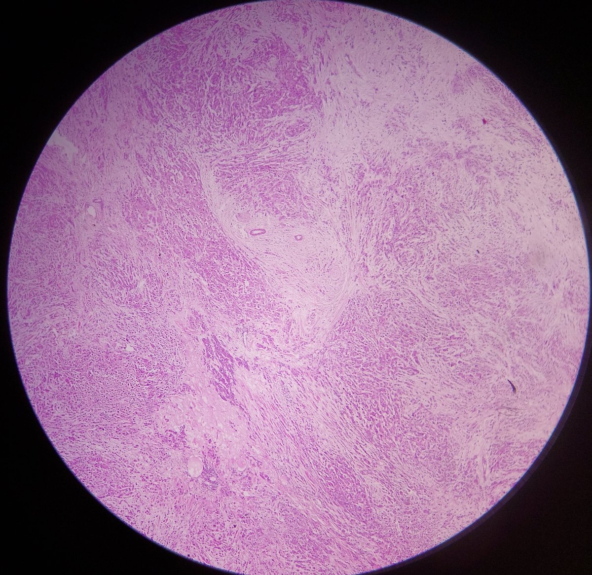 ViralBhanvadia's tweet photo. 52/M, orbital mass,mainly lower lid,max.size up to 5.5 cm, please opine. Thanks in advance. #eyepath #headneckpath #softissuepath @NewjobiRakesh @aanchalkakkar @drparomitaroy @Trupti2410 @01sth02 https://t.co/VRDZhl8ah1