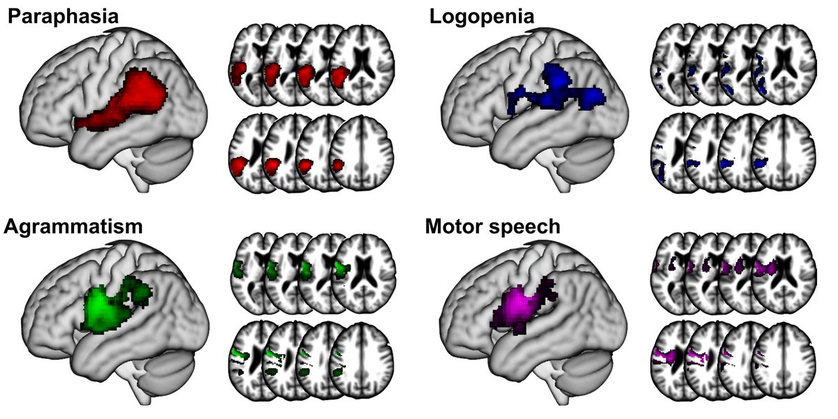 Casilio et al. explore how everyday conversation skills are disrupted in aphasia during the first week after stroke, and find that distinct regions in the left hemisphere language network are specialized for different aspects of speaking. tinyurl.com/3bmw7d3p