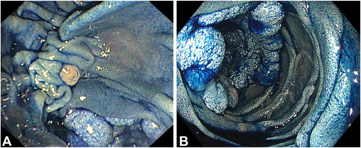 VideoGIE Journal (@videogie) on Twitter photo Fatih Aslan et al engage in "Pushing the boundaries: circumferential endoscopic submucosal dissection in distal duodenum" in this Original Article. videogie.org/article/S2468-…
<a href="/KaraRaphael/">Kara Raphael</a> Fatih Aslan et al engage in "Pushing the boundaries: circumferential endoscopic submucosal dissection in distal duodenum" in this Original Article. videogie.org/article/S2468-…
<a href="/KaraRaphael/">Kara Raphael</a>