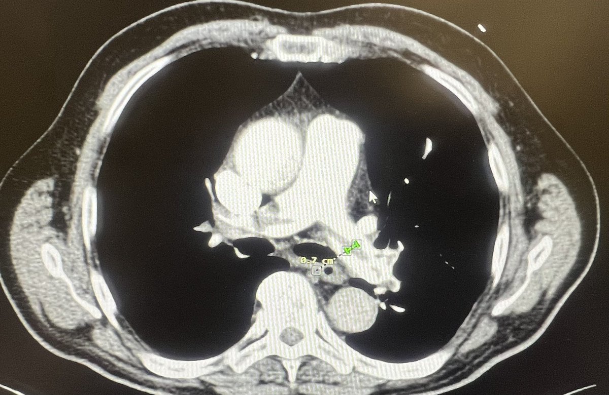 PertPoz's tweet photo. Happy to share first outside the US experience with #AlphaVAC in #IHR #PE with the #saddle embolism in main #PA🤩🤩🤩.Great deliverability and maneuverability,substantial clot debulking with on table #PA pressures normalisation 🫀🫁The excellent cooperation with cardiosurgeons👍 https://t.co/0wlw9PZDP7