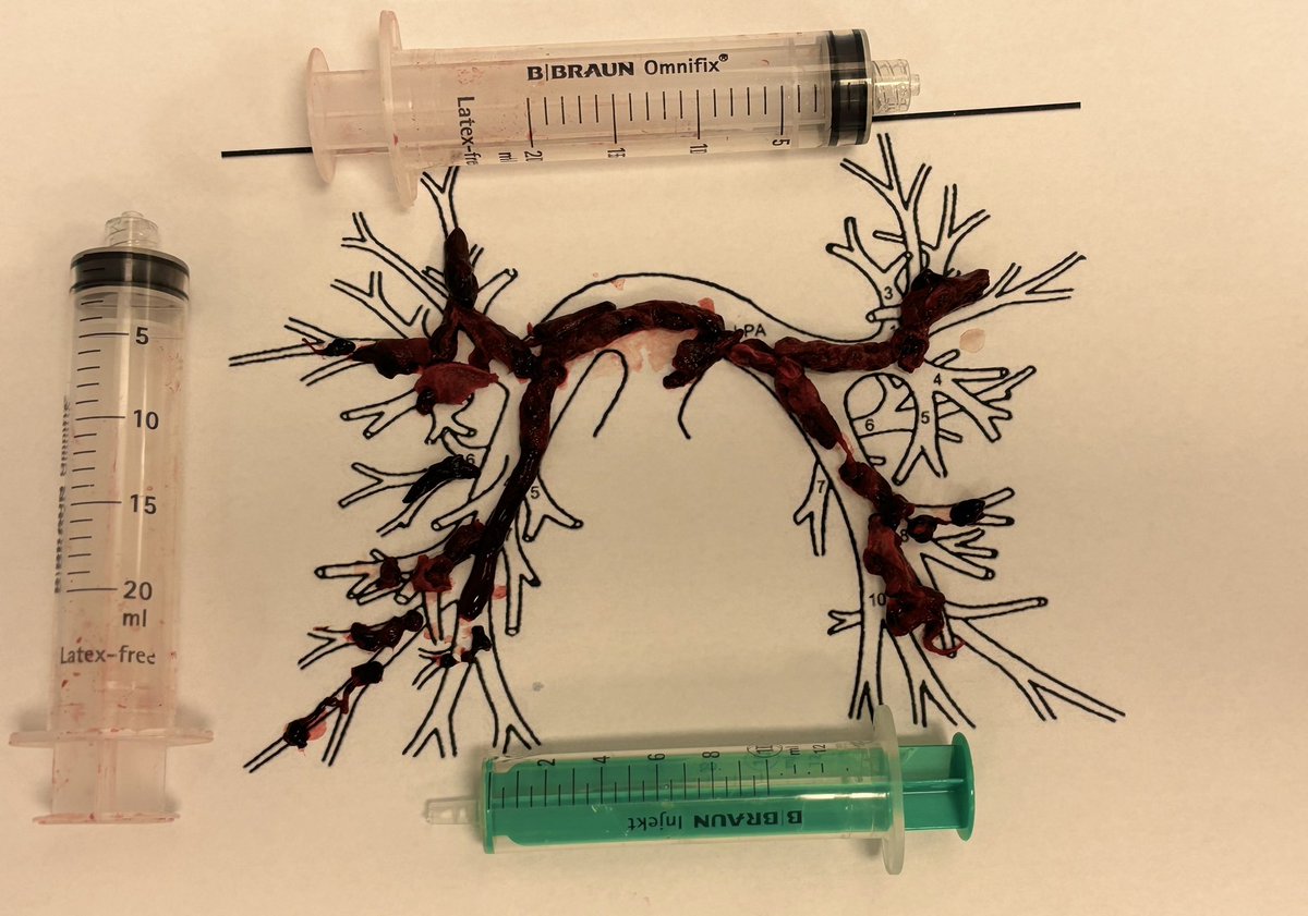 PertPoz's tweet photo. Happy to share first outside the US experience with #AlphaVAC in #IHR #PE with the #saddle embolism in main #PA🤩🤩🤩.Great deliverability and maneuverability,substantial clot debulking with on table #PA pressures normalisation 🫀🫁The excellent cooperation with cardiosurgeons👍 https://t.co/0wlw9PZDP7