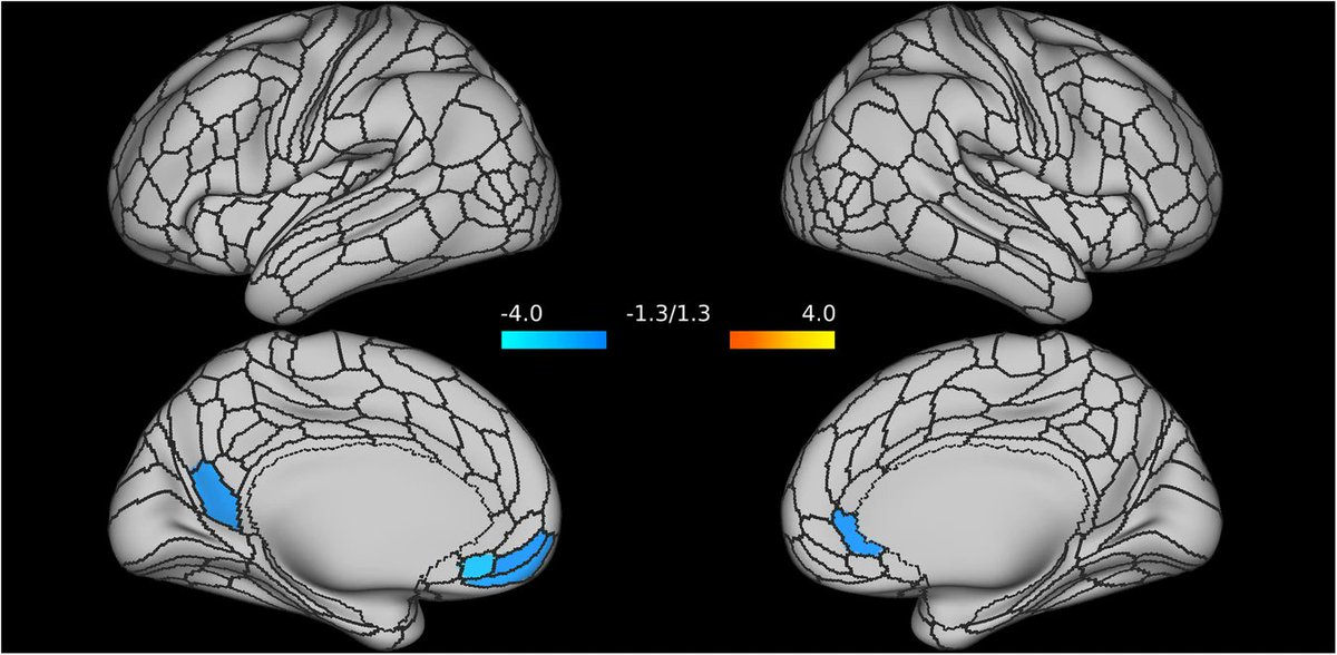 NPP-Digital Psychiatry and Neuroscience (@dpn_journal) on Twitter photo New research in <a href="/dpn_journal/">NPP-Digital Psychiatry and Neuroscience</a> unveils potentially distinct patterns of default mode network (DMN) connectivity between posttraumatic stress disorder (PTSD) and major depressive disorder (MDD) following mild acute stress. (🧵1/2)
rdcu.be/dLpKy New research in <a href="/dpn_journal/">NPP-Digital Psychiatry and Neuroscience</a> unveils potentially distinct patterns of default mode network (DMN) connectivity between posttraumatic stress disorder (PTSD) and major depressive disorder (MDD) following mild acute stress. (🧵1/2)
rdcu.be/dLpKy