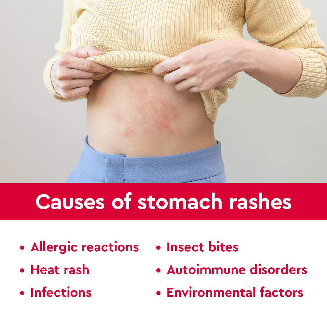 Got an itchy rash on your stomach? Don't scratch it! Check out our latest  article for tips on identifying and treating stomach rashes. Get the relief  you need and keep your skin, image size:1080x1080