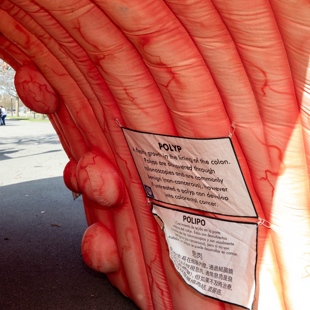 Colon Cancer Foundation (@coloncancerfdn) on Twitter photo Not us feeling bizarrely sentimental about an inflatable colon. 👀 The Rollin' Colon, along with most of our other educational resources, will go to CCA next month. We'll miss you, big guy. Keep rollin'. <a href="/CCAlliance/">Colorectal Cancer Alliance</a> Not us feeling bizarrely sentimental about an inflatable colon. 👀 The Rollin' Colon, along with most of our other educational resources, will go to CCA next month. We'll miss you, big guy. Keep rollin'. <a href="/CCAlliance/">Colorectal Cancer Alliance</a>