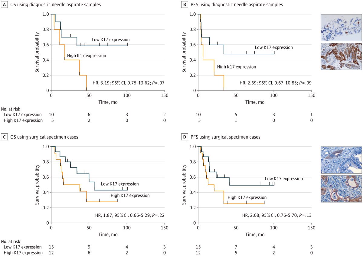 Anirban Maitra (@aiims1742) on Twitter photo New in <a href="/JAMAOnc/">JAMA Oncology</a>
Perioperative Modified FOLFIRINOX for Resectable #PancreaticCancer
jamanetwork.com/journals/jamao…
Single institution trial from <a href="/YaleCancer/">Yale Cancer Center</a> <a href="/Cecchini_OncMD/">Michael Cecchini</a> <a href="/Escobar_Lab/">Escobar-Hoyos Lab</a>
While the perioperative FOLFIRINOX question is mostly settled (trial ran from 2014 to 2021), the New in <a href="/JAMAOnc/">JAMA Oncology</a>
Perioperative Modified FOLFIRINOX for Resectable #PancreaticCancer
jamanetwork.com/journals/jamao…
Single institution trial from <a href="/YaleCancer/">Yale Cancer Center</a> <a href="/Cecchini_OncMD/">Michael Cecchini</a> <a href="/Escobar_Lab/">Escobar-Hoyos Lab</a>
While the perioperative FOLFIRINOX question is mostly settled (trial ran from 2014 to 2021), the