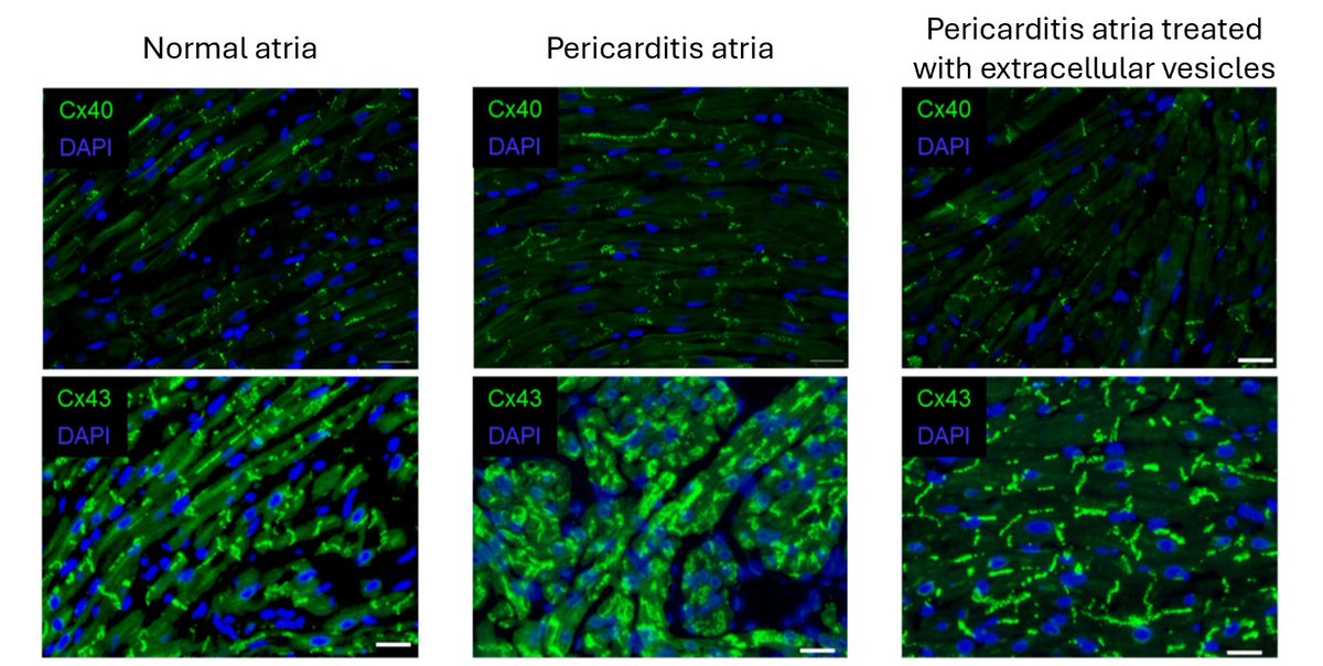 davis_ctrl's tweet image. Promising results: Treatment with extracellular vesicles prevents the adverse effects of pericarditis on connexin 43, improving atrial conduction and preventing atrial fibrillation. 🔗 doi:10.7150/thno.89520 #HeartResearch #ExtracellularVesicles #AtrialFibrillation