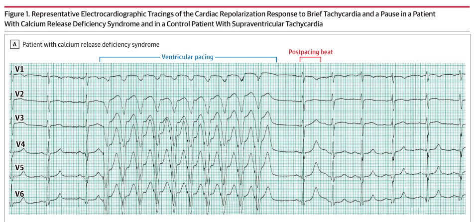 From <a href="/JAMA_current/">JAMA</a>: Preliminary results suggest that the repolarization response on an electrocardiogram to brief tachycardia followed by a pause may effectively diagnose calcium release deficiency syndrome (CRDS), a newly described cause of sudden death. ja.ma/3Vwy6h0