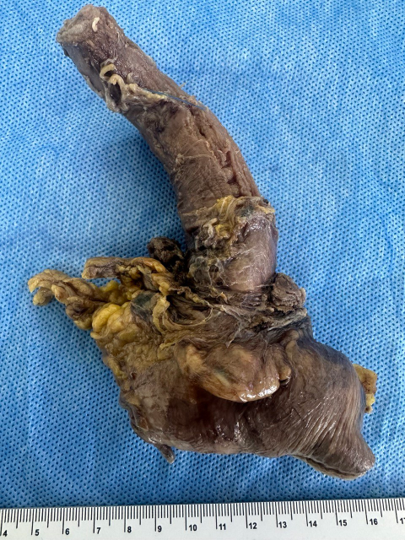 lorenaevilla's tweet photo. GROSS: ESOPHAGOGASTRECTOMY #GIpath  #pathoupic #pathAward #pathTwitter  #theartofgross #pathology  #pathologist https://t.co/G8tQBe1kro