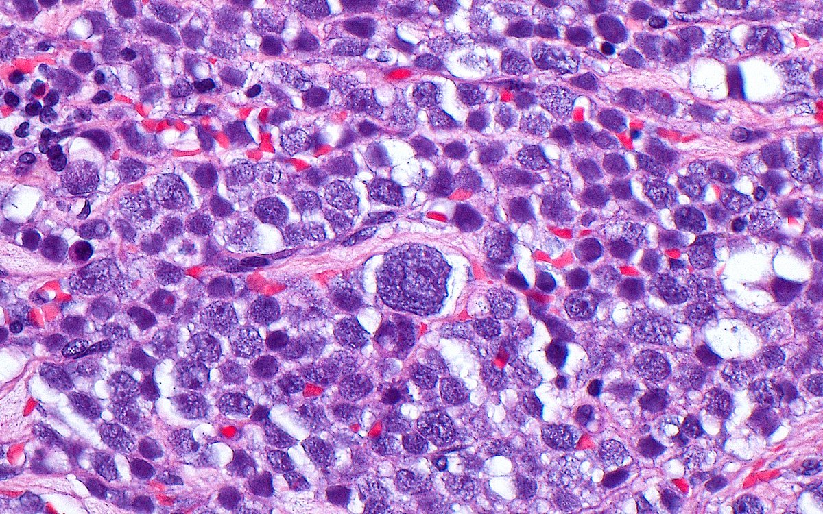 Spermatocytic Tumor ~ 🔬 #GUpath 
Remember 3 cell populations and sizes ◾️⬛️▪️ 
➡️ Giant cells (like the big one in the middle of picture!)
➡️ Small cells (fewer, smallest, dense chromatin look like lymphocytes!) 
➡️ Intermediate cells (the rest, most of the cells in the picture)