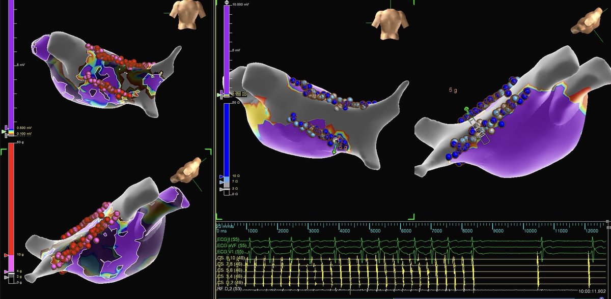 Was it correlation or causation? Peak frequency emphasis on #EnSiteX highlighted area of AF termination to NSR. 

#PMA 

<a href="/JeffHsingMD/">Jeff Hsing</a> 
<a href="/forkknifecab_EP/">Brock Gambill</a>