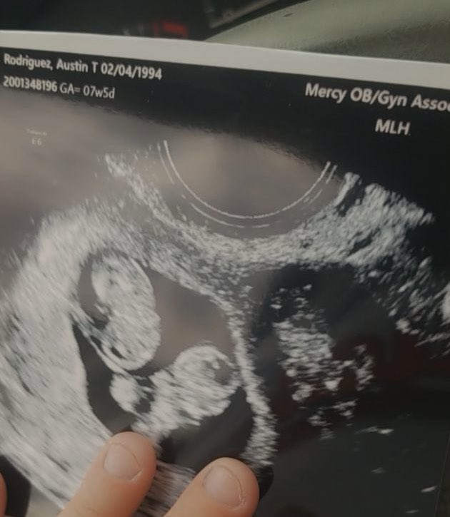 Apple53ider's tweet photo. As the day comes to an end, my mind has finally calmed down. 😞 3 years ago today was a happy yet terrifying day. What I thought was just ovarian pain…turned into having twins. Unfortunately, two weeks later, (July 3, 2021), they were gone.🤍🤍 #miscarriageawareness #iam1in4 https://t.co/aQixnLpErd