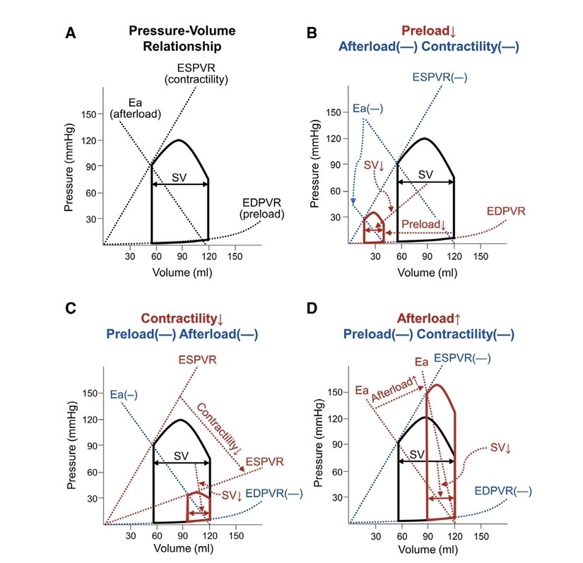 📣Causas del paro cardíaco🫀 perioperatorio: nemotecnia, clasificación, seguimiento y acciones
🔰 El paro cardíaco puede deberse a crisis de precarga, contractilidad, poscarga o crisis de frecuencia/ritmo.
👇🏽👇🏽👇🏽👇🏽👇🏽
journals.lww.com/anesthesia-ana…
🗝🔓
acrobat.adobe.com/link/review?ur…