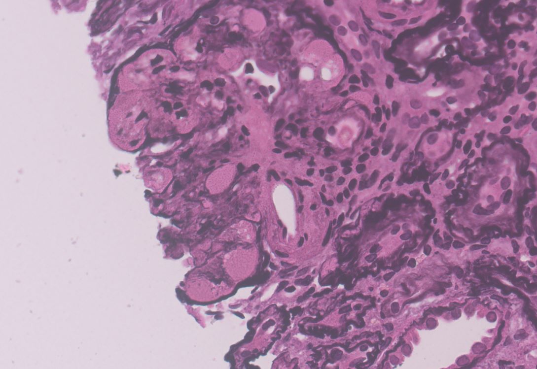 DrPathGirl's tweet photo. @JZRenalPath 
40yr old female with sr creat of 12 UPCR- 11, hypertensive since 3 yrs and taking some Ayurvedic medication which she has stopped 6 Month's back. Congo Red is negative, IF is almost negative. End stage disease with these changes https://t.co/MUg8ciJIQg