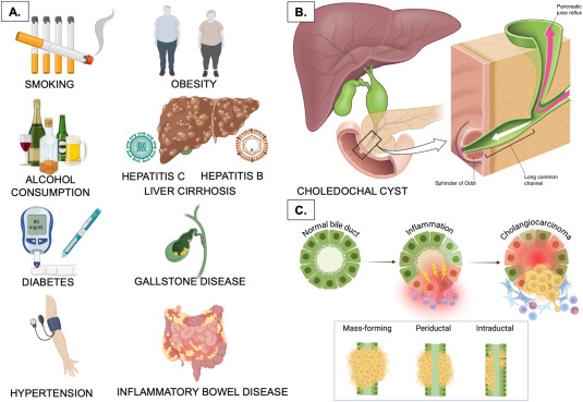 Kjetil Søreide (@ksoreide) on Twitter photo Biliary tract cancer: Discussing cholangiocarcinoma, core curriculum, useful for candidates for the EBSQ exam <a href="/ESSOnews/">European Society of Surgical Oncology (ESSO)</a> <a href="/EAHPBA/">E-AHPBA</a> <a href="/UEMSEurope/">UEMS Europe</a> Great collab ✍️ w <a href="/cdopazo1/">Cristina Dopazo</a> <a href="/SStattner/">Shelley Stattner</a> <a href="/LuciaCarrionA/">Lucia Carrion-Alvarez</a> BodilAndersson <a href="/berrevoet/">FrederikBerrevoet</a> Rafa Diaz-Nieto
sciencedirect.com/science/articl… Biliary tract cancer: Discussing cholangiocarcinoma, core curriculum, useful for candidates for the EBSQ exam <a href="/ESSOnews/">European Society of Surgical Oncology (ESSO)</a> <a href="/EAHPBA/">E-AHPBA</a> <a href="/UEMSEurope/">UEMS Europe</a> Great collab ✍️ w <a href="/cdopazo1/">Cristina Dopazo</a> <a href="/SStattner/">Shelley Stattner</a> <a href="/LuciaCarrionA/">Lucia Carrion-Alvarez</a> BodilAndersson <a href="/berrevoet/">FrederikBerrevoet</a> Rafa Diaz-Nieto
sciencedirect.com/science/articl…