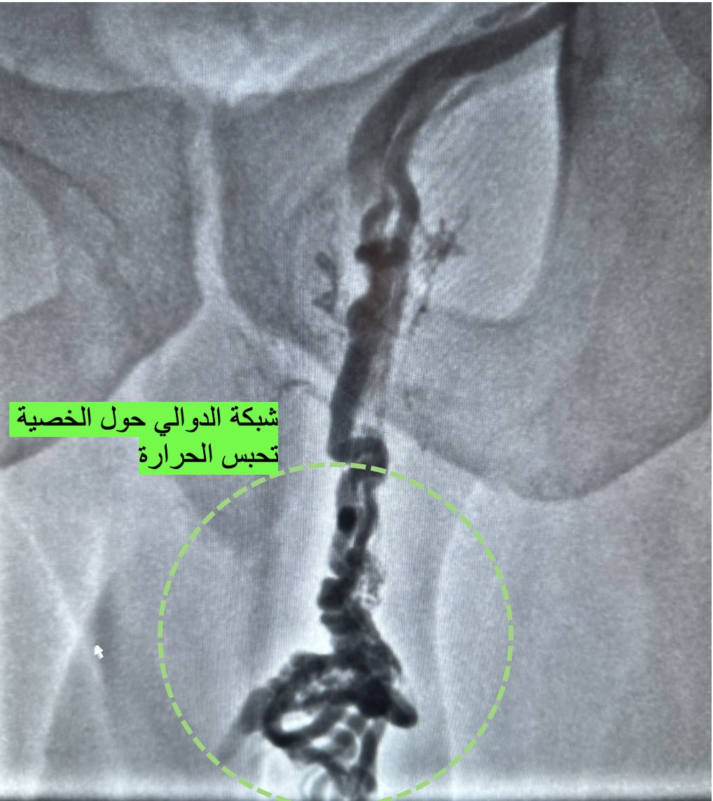 علاج دوالي الخصية بالقسطرة:
- علاج الارتجاع من اعلى الظهر (لتقليل نسبة العودة مثل هذه الحالة التي عملت بالمجهر)
- علاج جميع دوالي الخصية (حتى الصغيرة منها ولا يمكن رؤيتها بالمجهر/المايكروسكوب - كما هو موضح)
- علاج شبكة الدوالي حول الخصية (لا تربط جراحياً)
- عدم لمس القنوات