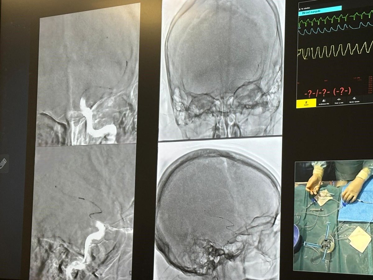 VESALIOcom's tweet photo. #Stroke experts #DoTheDropZone and view live #NeVa cases at Vesalio's Barcelona Clot Interaction Workshop.Thanks to faculty, Drs @jtorresmacho @atomasell #MarcRibo #DavidHernandez #TomasCarmona @ManuRequenaRuiz.
Look forward to #NeVaFirstPass from attendees!
@Diane_Demet https://t.co/WYmQldN3JU