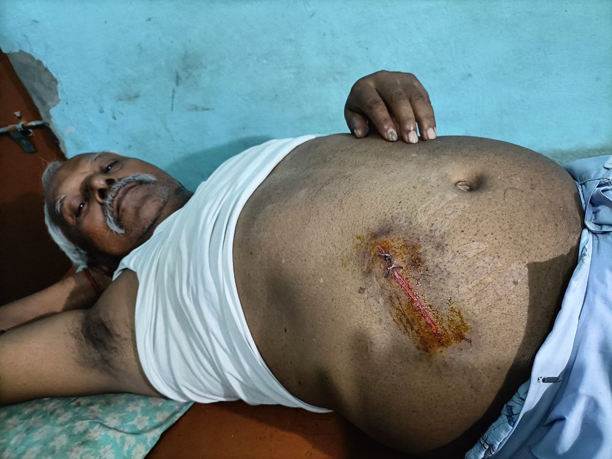 mlaShubhamgupta's tweet image. @sultanpurpolice 
 @myogiadityanath 
 आज-कल Police इतना भ्रष्ट हो गयी है बिना पैसे के कोई काम भी नहीं करती.मेरे नाना जी सो रहे थे,को कुल्हाड़ी से मारने का प्रयास किया गया. पुलिस विपक्षी से पैसे लेकर जो धारा लगना चाहिए usko badlwa diya.आम आदमी सुरक्षित नहीं
#ShameonAkhandnagarpoli