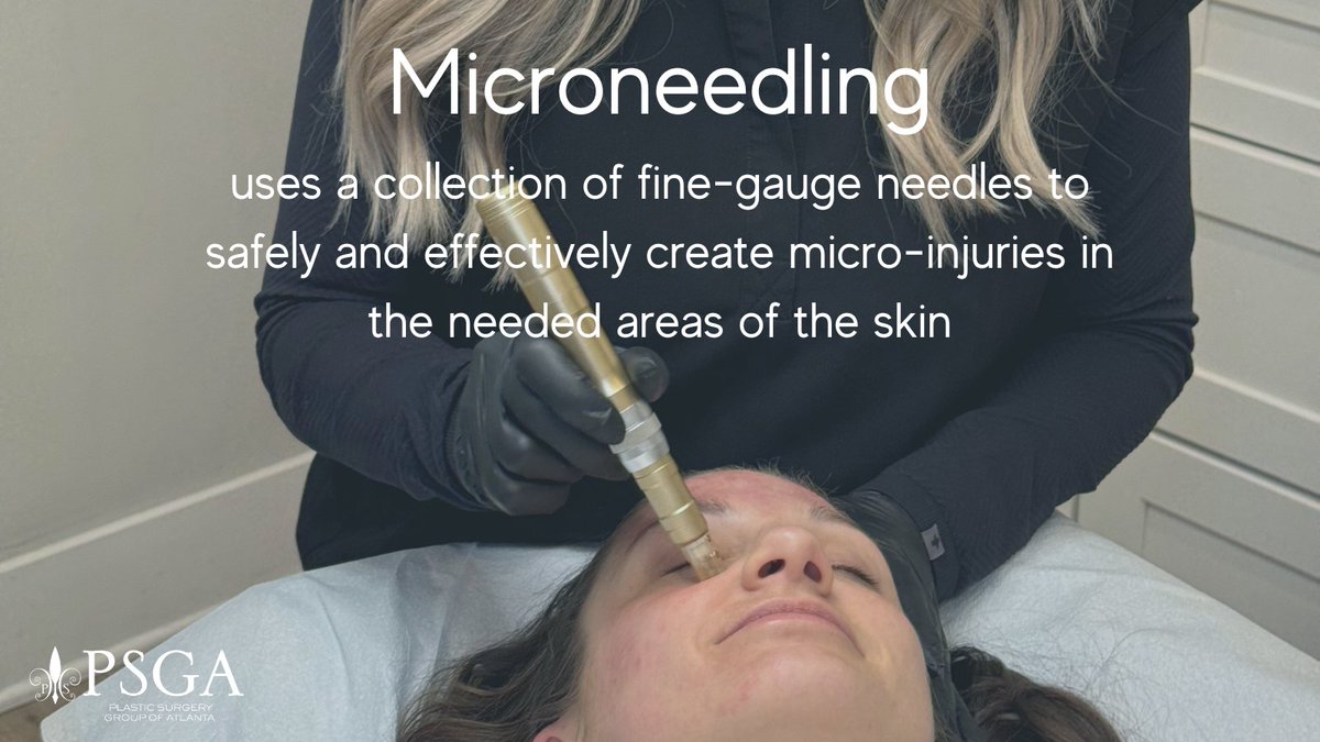 When home skin care products aren’t effective but you aren’t ready for surgery, consider non-surgical skin rejuvenation treatments like microneedling with Lisa Garveigh and Carey Dickerson to help bring back your natural glow.
#Microneedling #GlowingSkin
📞 Call 404-348-4456
