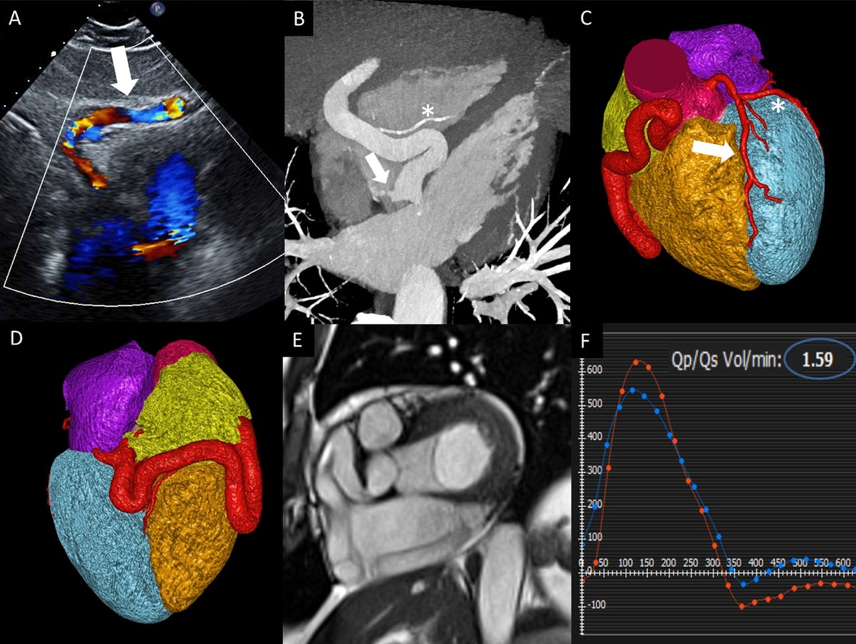 Multimodality assessment of a coronary artery aneurysm with arteriovenous fistula #REC #AheadOfPrint revespcardiol.org//en-multimodal…
