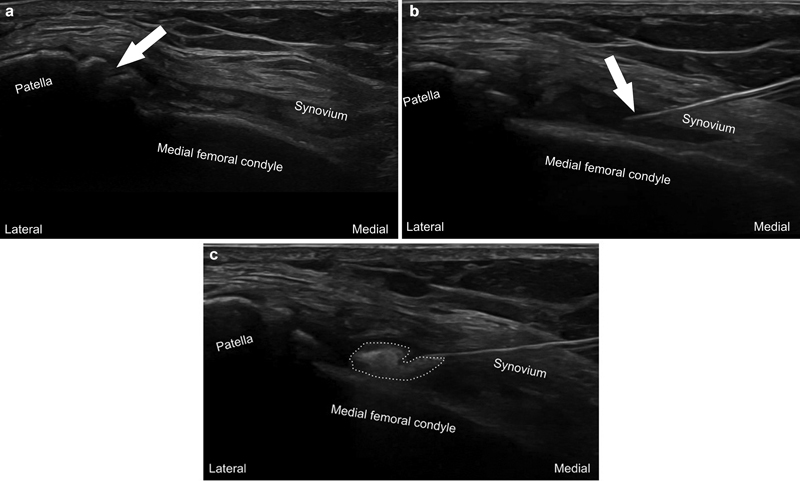 Weill Cornell Medicine Radiology (@wcmradiology) on Twitter photo 🦵 Read "Advanced Interventional Procedures for Knee Osteoarthritis: What Is the Current Evidence?", a recent review from <a href="/doctorholz/">Dan Holzwanger, MD</a> in <a href="/SMR_SeminarsMSK/">Seminars in Musculoskeletal Radiology</a>, the official journal of <a href="/ESSRmsk/">European Society of Musculoskeletal Radiology</a>, here 👉 tinyurl.com/35jm3y5x 🦵 Read "Advanced Interventional Procedures for Knee Osteoarthritis: What Is the Current Evidence?", a recent review from <a href="/doctorholz/">Dan Holzwanger, MD</a> in <a href="/SMR_SeminarsMSK/">Seminars in Musculoskeletal Radiology</a>, the official journal of <a href="/ESSRmsk/">European Society of Musculoskeletal Radiology</a>, here 👉 tinyurl.com/35jm3y5x
