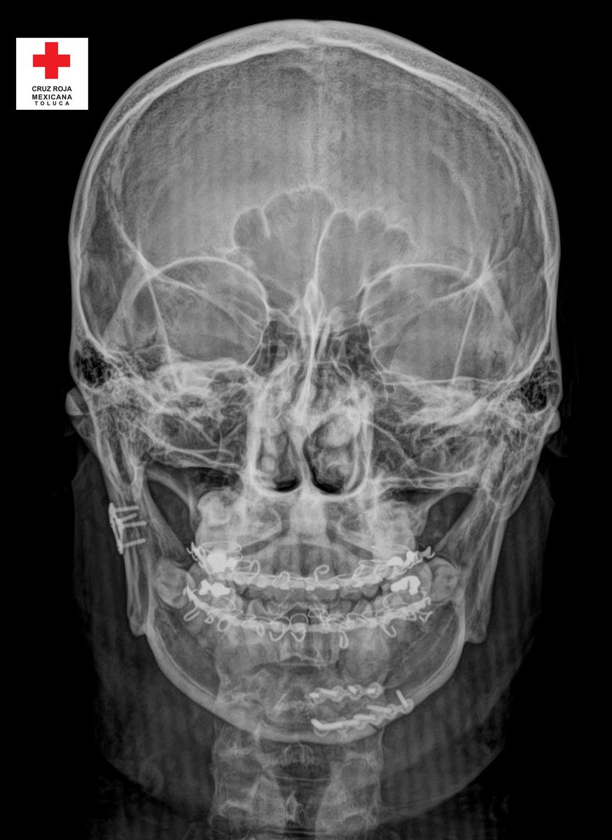 Nuestro equipo médico y dental realizó la primera cirugía Maxilo Facial, a bajo costo, en los quirófanos de <a href="/CRMTOLUCA/">Cruz Roja Toluca</a>.
La exitosa intervención quirúrgica fue una Reducción Abierta y Fijación Interna (RaFi) doble de mandíbula, mediante la colocación de dos placas metálicas y la