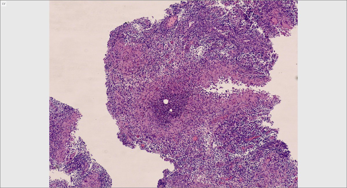 MirunaPopescu13's tweet photo. Chalazion - blepharitis
👩🏼young adults
👁️upper>lower eyelid, inflammation around sebaceous gl ducts
🔬Lipogranulomas (empty space surrounded by granulomatous inflammation)
🔬Early lesions->neutrophilic granulomas
🔬Granulation tissue, fibrosis
#pathoutpic #PathTwitter #Eyepath https://t.co/zVTwNoyeXW