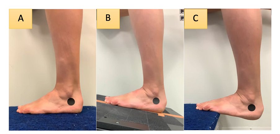 Kim Hébert-Losier (@kimhebertlosier) on Twitter photo It is finally out! We examined the effects of foot starting position on calf raise / heel rise test outcomes with Dr Fernandez, <a href="/Seth0Neill/">Achilles Tendons</a>, Prof Kubo, Dr Athens sciencedirect.com/science/articl… It is finally out! We examined the effects of foot starting position on calf raise / heel rise test outcomes with Dr Fernandez, <a href="/Seth0Neill/">Achilles Tendons</a>, Prof Kubo, Dr Athens sciencedirect.com/science/articl…