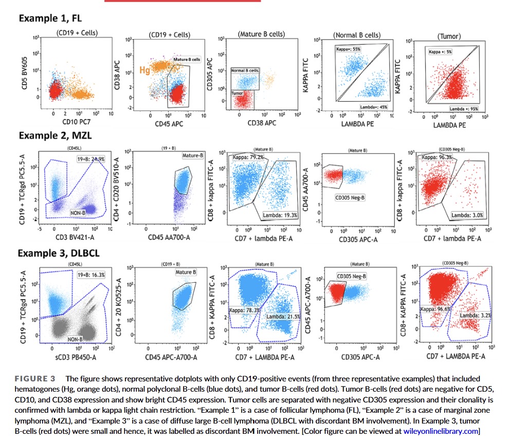 Happy to share our experience on CD305 in minimal BM involvement by B-NHL <a href="/AmeetRKini/">Ameet Kini, MD, PhD</a> <a href="/CytometryIndia/">THE CYTOMETRY SOCIETY</a> <a href="/DrAnilHandoo/">Dr Anil Handoo</a> <a href="/ananthvikas/">ananthvikas</a> <a href="/drkunalsehgal/">Kunal Sehgal</a> <a href="/DrArunCMC/">Arun Kumar Arunachalam</a> <a href="/gvencut1/">Girish Venkataraman</a> <a href="/LakshmiKoulmane/">Sindhura Lakshmi</a> <a href="/sindhucherian/">cherians</a> <a href="/ICCS_Education/">ICCS_Education</a> <a href="/sanamloghavi/">Sanam Loghavi, MD صنم لغوی 🔬🧬</a> <a href="/KBommannan/">Karthik Bommannan</a> <a href="/bagalbp/">Bhausaheb Bagal</a> <a href="/RajpalSweta/">Sweta Rajpal</a> <a href="/Gaurav_C42/">Gaurav Chatterjee</a>