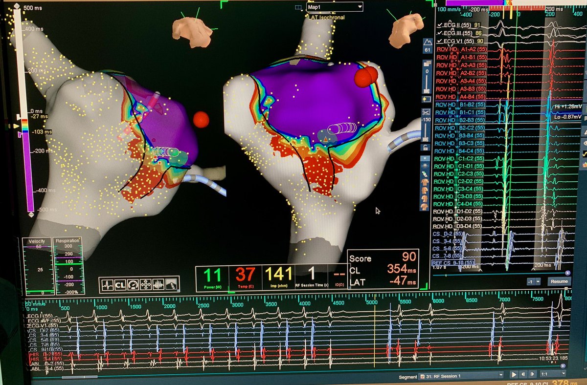 sabarisarav's tweet image. OWM - avrt !!! 1 sec 🔥 RF 1 , Fun!
#HDGrid  
Tx @UlhasDr @anindya_0211 

@AbbottCardio @dineshkrishn @Harishs1794 @Yogesh_EP @murphy_lzy @rahul_bme53 @RYeddanapudi @jeffzhanghk2022